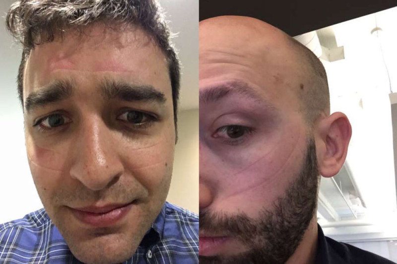 Are You Suffering From Oculus Face or Rift Rash?